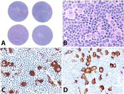 High Counts of CD68+ and CD163+ Macrophages in Mantle Cell Lymphoma Are Associated With Inferior Prognosis